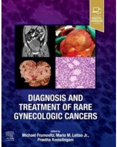Diagnosis and Treatment of Rare Gynecologic Cancers