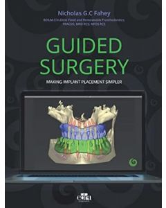 Guided Surgery. Making implant placement simpler