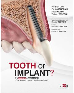 Tooth or Implant?: The recovery or replacement of the severely compromised natural tooth